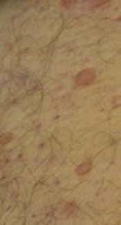 <i>Nocardia cyriacigeorgica</i>: A Case of Disseminated Infection in an Immunocompromised Patient