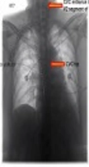 Endovascular Management, JACC