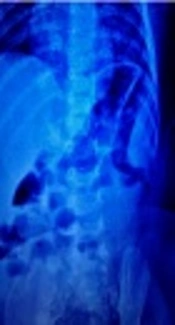 Afebrile Kawasaki Disease Presenting as Intestinal
          Pseudo-Obstruction