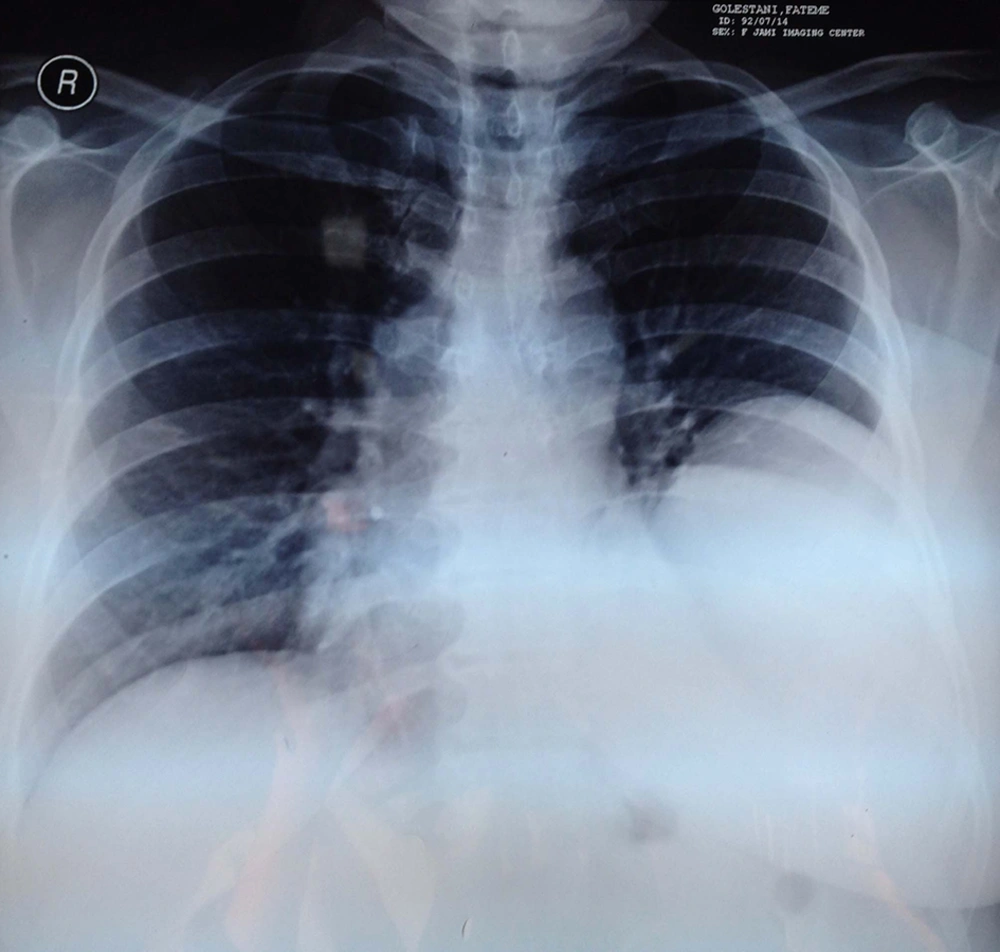 Chest Radiography on Admission Chest Radiography on Admission