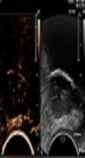 Contrast-Enhanced Ultrasound Characteristics of Bladder Leiomyoma: A Case Report
