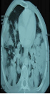 Visceral Leishmaniasis with Massive Pulmonary Involvement: A Case Report