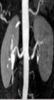 Correlations and Differences in Glomerular Filtration Rates Calculated Through In-House and Non-In-House Workstations of Scintigraphic Gamma Cameras