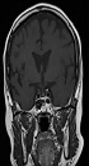 Fluconazole as a Safe and Effective Alternative to Ketoconazole in Controlling Hypercortisolism of Recurrent Cushing’s Disease: A Case Report