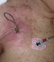 International Journal of Infection