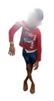 Upper Extremity Impairments and Activities in Children with Bilateral Cerebral Palsy