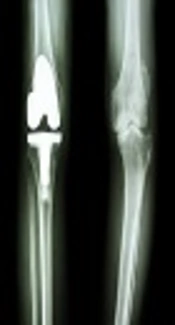 Effect of Dexmedetomidine Infusion During Orthopedic Surgery on Postoperative Analgesic Consumption in Opium Addict Patients; A Randomized Clinical Trial