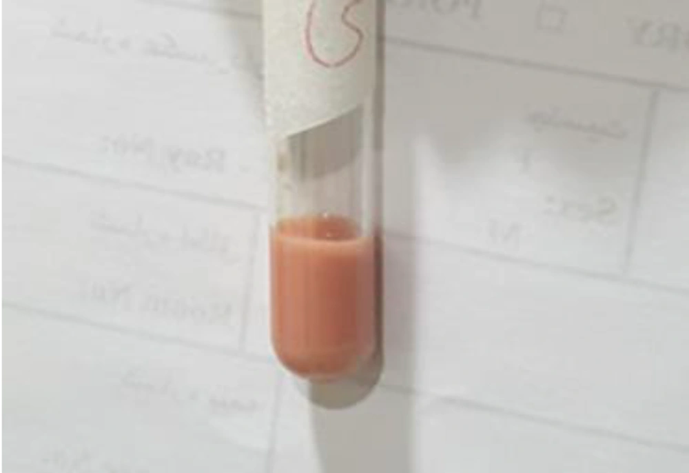 Blood sample of patient after centrifugation Blood sample of patient after centrifugation