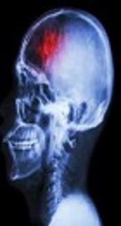 Evaluation of the Relationship Between Serum Sodium Concentration and Mortality Rate in ICU Patients with Traumatic Brain Injury
