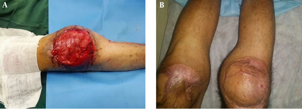 A, Right knee after the medial head gastrocnemius flap; B, the view of the patient’s knees after three months. A, Right knee after the medial head gastrocnemius flap; B, the view of the patient’s knees after three months.