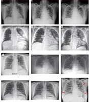 Archives of Clinical Infectious Diseases 