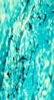 Candidemia in Children Caused by Uncommon Species of <i>Candida</i>