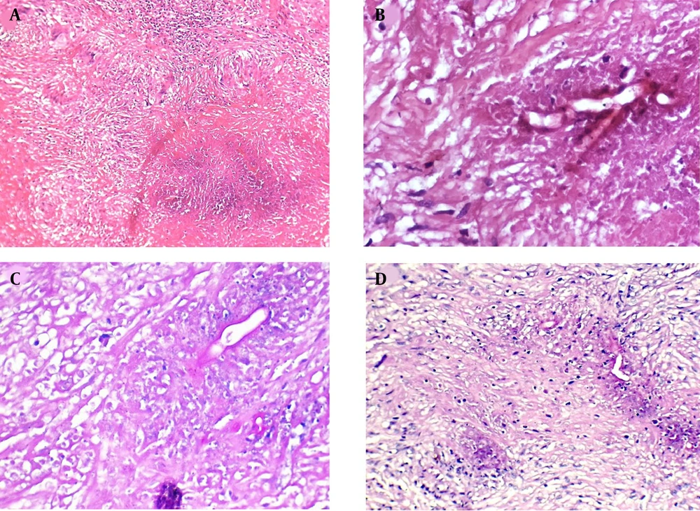 A, Necrotizing granulomatous inflammation (H&E, X100); B, eosinophilic cuff surrounding the hyphae, characteristic of the Splendore–Hoeppli phenomenon (H&E, X400); C, broad-based hyphae of basidiobolomycosis (PAS, X400); D, fungal hyphae within necrotic debris (H&E, X200). A, Necrotizing granulomatous inflammation (H&E, X100); B, eosinophilic cuff surrounding the hyphae, characteristic of the Splendore–Hoeppli phenomenon (H&E, X400); C, broad-based hyphae of basidiobolomycosis (PAS, X400); D, fungal hyphae within necrotic debris (H&E, X200).