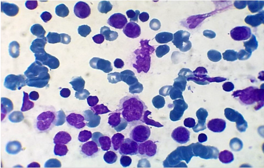Peripheral Blood Film (Wright-Gimsa X1000) Shows Monocytosis and Lymphocytosis with Occasional Promonocytes and Blasts Peripheral Blood Film (Wright-Gimsa X1000) Shows Monocytosis and Lymphocytosis with Occasional Promonocytes and Blasts