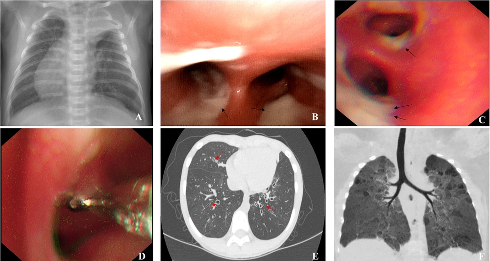 Representative bronchoscopy and computed tomography (CT) images: A, atelectasis of left upper lobe, right heart, and total visceral inversion (case 4); B, abundant viscous sputum as seen under bronchoscope (case 1); C, abundant thick sputum observed under bronchoscope (case 8); D, bronchial mucosal biopsy (case 8); E, chest CT image showing extensive bronchiectasis (case 3); F, CT reconstruction showing bronchopulmonary dysplasia-induced airway changes (case 16) Representative bronchoscopy and computed tomography (CT) images: A, atelectasis of left upper lobe, right heart, and total visceral inversion (case 4); B, abundant viscous sputum as seen under bronchoscope (case 1); C, abundant thick sputum observed under bronchoscope (case 8); D, bronchial mucosal biopsy (case 8); E, chest CT image showing extensive bronchiectasis (case 3); F, CT reconstruction showing bronchopulmonary dysplasia-induced airway changes (case 16)