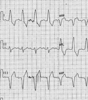 Jundishapur J Chronic Dis Care