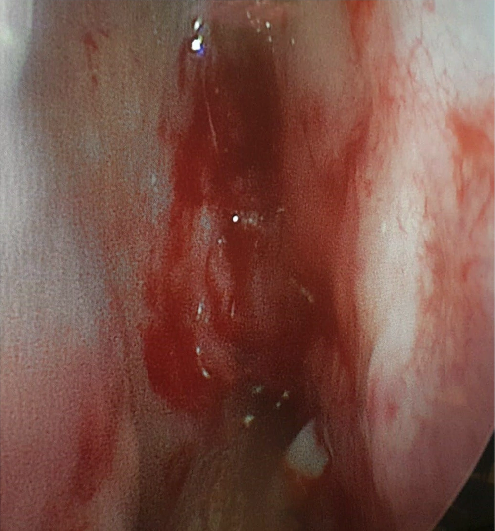 Endoscopic view of the right nasal cavity showing the choanal atresia Endoscopic view of the right nasal cavity showing the choanal atresia