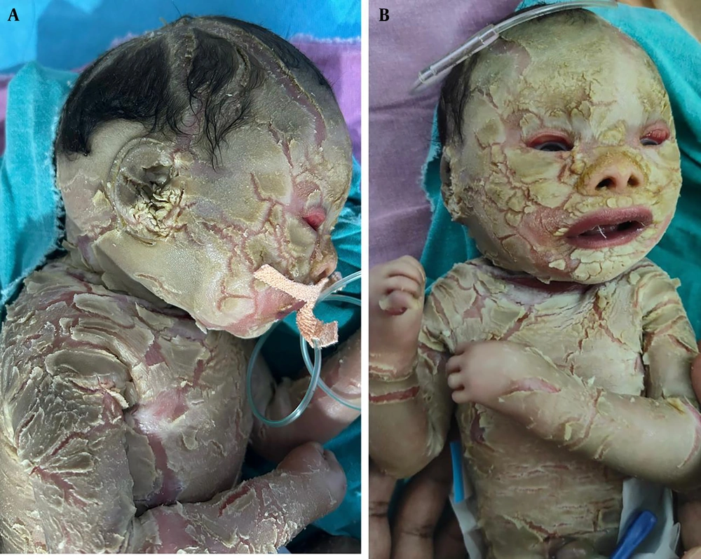 A and B, case 3 is a severe collodion baby with thick scales, erythema A and B, case 3 is a severe collodion baby with thick scales, erythema