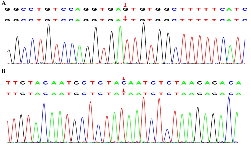 Gene sequencing results obtained for some of the children: A, BTK c.1631 + 5G > T mutation (case 8); B, ATM c.6397C > T mutation (case 9) Gene sequencing results obtained for some of the children: A, BTK c.1631 + 5G > T mutation (case 8); B, ATM c.6397C > T mutation (case 9)