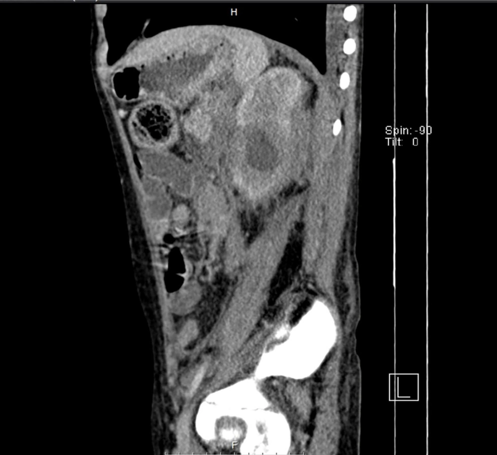 Contrast-enhanced CT demonstrating a retroperitoneal mass compressing major vessels and surrounding structures in the presented case. Contrast-enhanced CT demonstrating a retroperitoneal mass compressing major vessels and surrounding structures in the presented case.