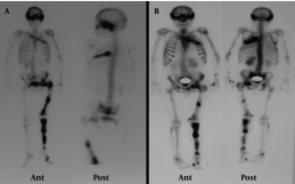 Patient’s previous whole body bone scan (A) showed increased osteoblastic activity in the cranium, left hemithorax, bilateral upper and lower extremities and pelvic bones. The recent bone scan (B) shows that the polyostotic FDB lesions are compatible with the previous bone scan and the recent FDG PET/CT scan. Patient’s previous whole body bone scan (A) showed increased osteoblastic activity in the cranium, left hemithorax, bilateral upper and lower extremities and pelvic bones. The recent bone scan (B) shows that the polyostotic FDB lesions are compatible with the previous bone scan and the recent FDG PET/CT scan.