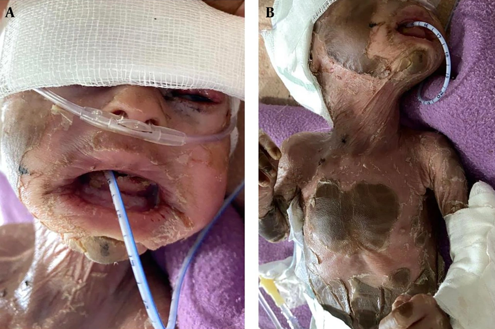 A and B, case 1 with improvement after managing with oral isotretinoin in 2 weeks A and B, case 1 with improvement after managing with oral isotretinoin in 2 weeks