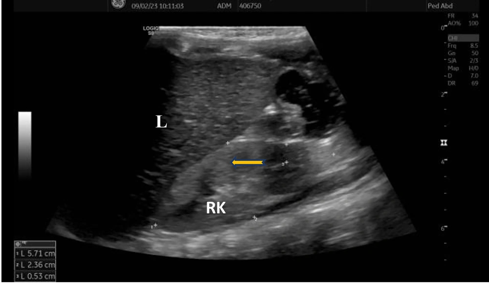 Renal ultrasonography revealing increased kidney echogenicity with loss of corticomedullary differentiation (arrow); (Abbreviations: L, liver; RK, right kidney). Renal ultrasonography revealing increased kidney echogenicity with loss of corticomedullary differentiation (arrow); (Abbreviations: L, liver; RK, right kidney).