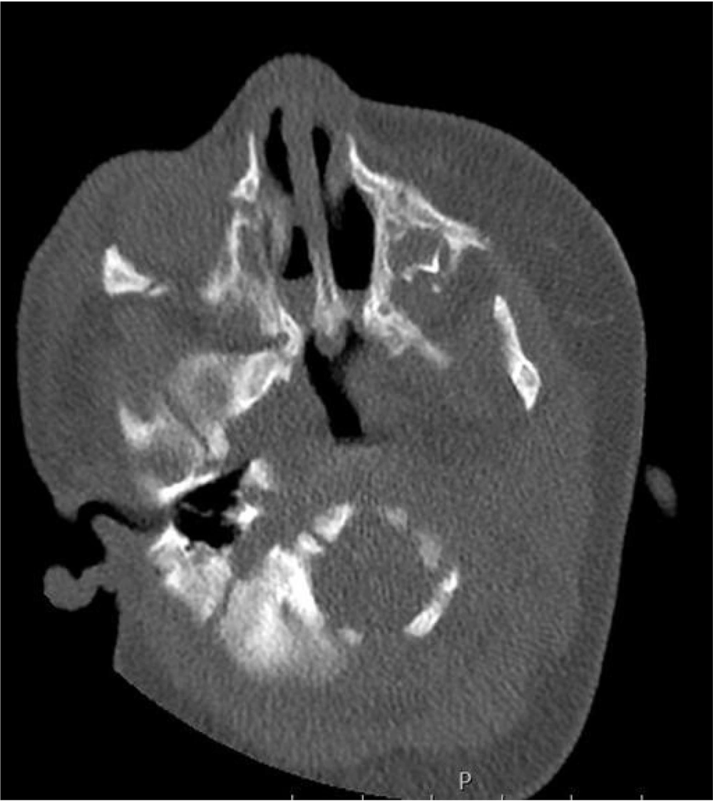 Membranous choanal atresia: On the non-contrast axial CT section of a 6-year- old female patient, bands of soft tissue density can be seen at the posterior choanal level. Note that the vomer width is normal. Membranous choanal atresia: On the non-contrast axial CT section of a 6-year- old female patient, bands of soft tissue density can be seen at the posterior choanal level. Note that the vomer width is normal.