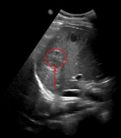 Pyogenic Liver Abscess Following Incision and Drainage of a Perianal ...