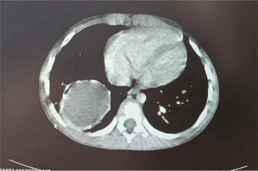 Lung computed tomography (CT) scan of the patient showed right lung cyst. Lung computed tomography (CT) scan of the patient showed right lung cyst.