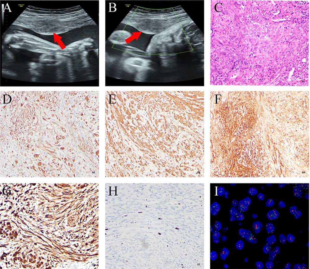 Imaging and pathological findings of inflammatory myofibroblastic tumor (IMT): A and B, the ultrasound examination at 29 weeks of pregnancy revealed a single live fetus and a 35 × 23 mm<sup>2</sup> occupying lesion within the uterus; C, hematoxylin and eosin staining revealed that tumor cells were arranged in bundles, and the stroma was infiltrated with lymphocytes and plasma cells at a magnification of 100X; D – H, the immunohistochemical analysis demonstrated positive staining for desmin (D), SMA (E), CD10 (F), and anaplastic lymphoma kinase (ALK) (G), with a Ki67 positive rate of less than 10% (H), all observed at a magnification of 100X; I, fluorescence in situ hybridization (FISH) for detecting ALK rearrangement. Imaging and pathological findings of inflammatory myofibroblastic tumor (IMT): A and B, the ultrasound examination at 29 weeks of pregnancy revealed a single live fetus and a 35 × 23 mm<sup>2</sup> occupying lesion within the uterus; C, hematoxylin and eosin staining revealed that tumor cells were arranged in bundles, and the stroma was infiltrated with lymphocytes and plasma cells at a magnification of 100X; D – H, the immunohistochemical analysis demonstrated positive staining for desmin (D), SMA (E), CD10 (F), and anaplastic lymphoma kinase (ALK) (G), with a Ki67 positive rate of less than 10% (H), all observed at a magnification of 100X; I, fluorescence in situ hybridization (FISH) for detecting ALK rearrangement.