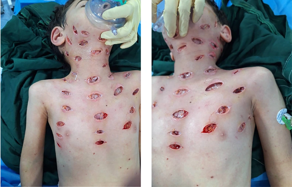 The lesions on the left neck, chest and face showed signs of early tissue necrosis The lesions on the left neck, chest and face showed signs of early tissue necrosis