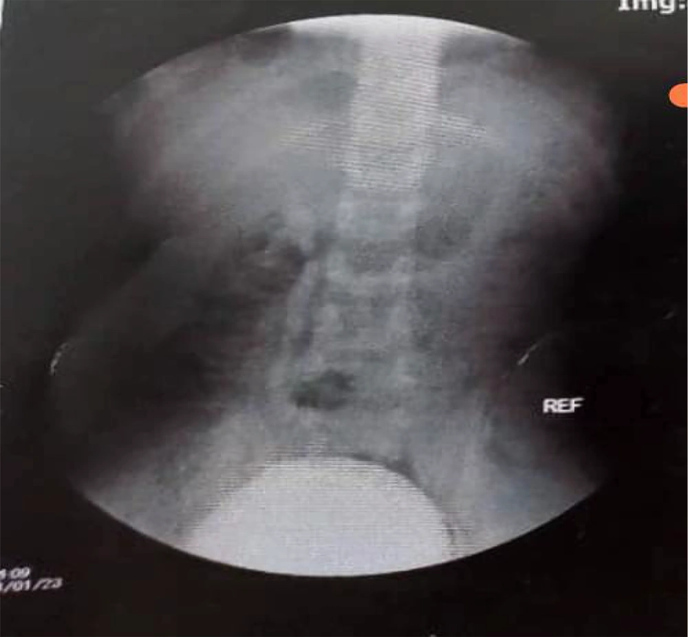 Voiding cystourethrogram (VCUG) of the patient Voiding cystourethrogram (VCUG) of the patient