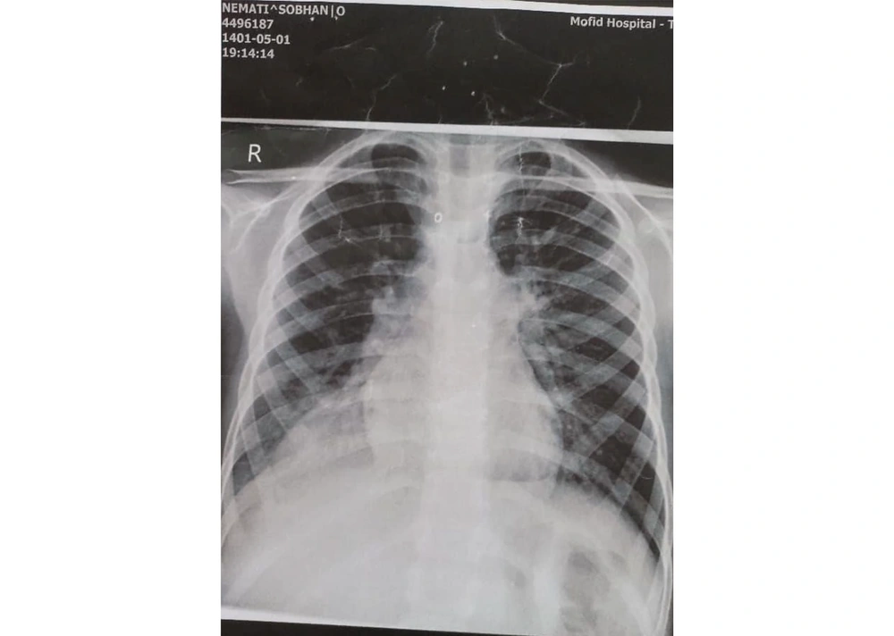 Chest X-ray (CXR) of the patient showed right lung involvement, mild cardiomegaly and increased pulmonary blood flow. Chest X-ray (CXR) of the patient showed right lung involvement, mild cardiomegaly and increased pulmonary blood flow.