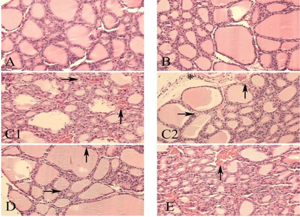 Thyroid tissue: A, control group showing normal thyroid tissue architecture; B, black walnut extract group showing normal histological appearance; C, methimazole group exhibiting vascular congestion (↑), vacuolar degeneration (→), and inflammatory cell infiltration (*); D, methimazole + black walnut extract group showing vascular congestion (↑) and vacuolar degeneration (→), with no inflammatory infiltration; E, methimazole + levothyroxine group showing vascular congestion (↑), with no other pathological findings (abbreviation: H&E, hematoxylin and eosin staining; magnification 40x). Thyroid tissue: A, control group showing normal thyroid tissue architecture; B, black walnut extract group showing normal histological appearance; C, methimazole group exhibiting vascular congestion (↑), vacuolar degeneration (→), and inflammatory cell infiltration (*); D, methimazole + black walnut extract group showing vascular congestion (↑) and vacuolar degeneration (→), with no inflammatory infiltration; E, methimazole + levothyroxine group showing vascular congestion (↑), with no other pathological findings (abbreviation: H&E, hematoxylin and eosin staining; magnification 40x).