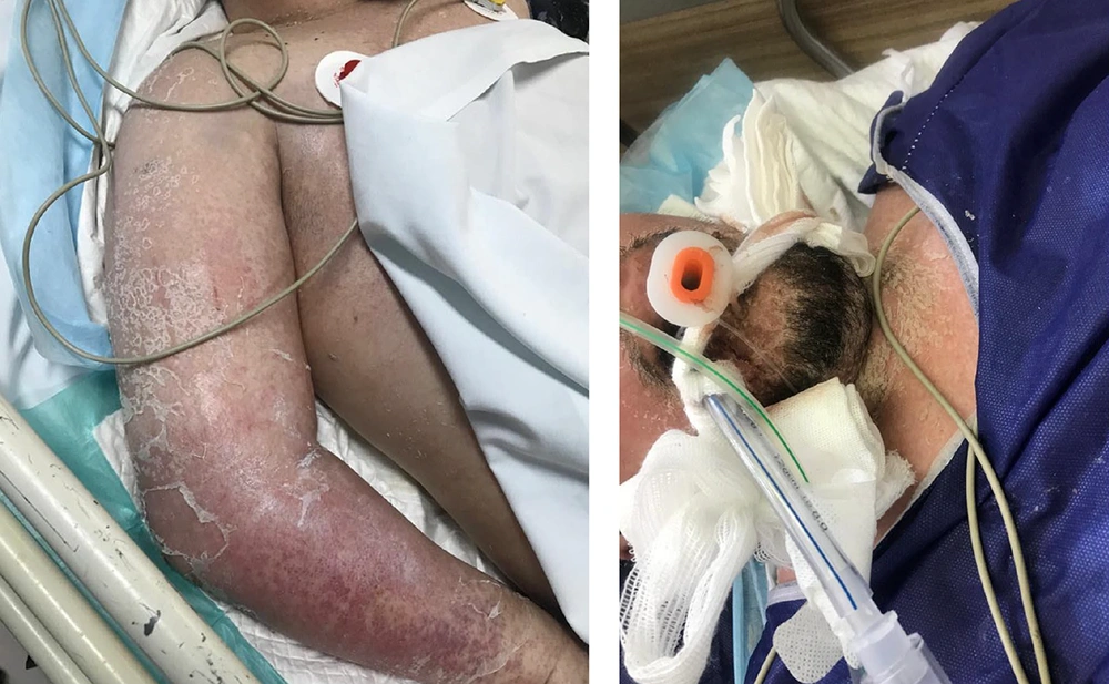 Cutaneous manifestations in the patient with lamotrigine-induced drug reaction with eosinophilia and systemic symptoms (DRESS) syndrome Cutaneous manifestations in the patient with lamotrigine-induced drug reaction with eosinophilia and systemic symptoms (DRESS) syndrome