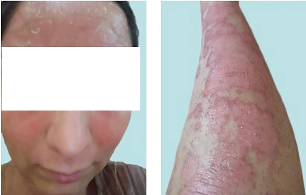 Post-treatment skin images of face lesions (left), and (representative) lower extremity (right), ~ 2 months (late august, 2023) after the first intervention attempt using InflAQ (twice a day), along with vaseline/petroleum jelly (twice a day) as an emollient. Post-treatment skin images of face lesions (left), and (representative) lower extremity (right), ~ 2 months (late august, 2023) after the first intervention attempt using InflAQ (twice a day), along with vaseline/petroleum jelly (twice a day) as an emollient.