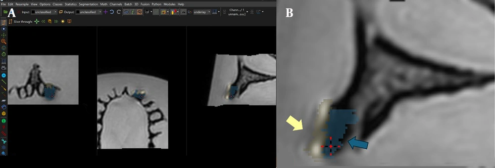 Imalytics software environment used for artifact quantification: A, Software interface showing artifact classification in axial, coronal, and sagittal planes; and B, Zoomed-in view of the classified regions, with pile-up indicated by yellow arrows and signal loss indicated by blue arrows. The ‘Statistics’ tab displays corresponding artifact volumes (mm<sup>3</sup>). Imalytics software environment used for artifact quantification: A, Software interface showing artifact classification in axial, coronal, and sagittal planes; and B, Zoomed-in view of the classified regions, with pile-up indicated by yellow arrows and signal loss indicated by blue arrows. The ‘Statistics’ tab displays corresponding artifact volumes (mm<sup>3</sup>).