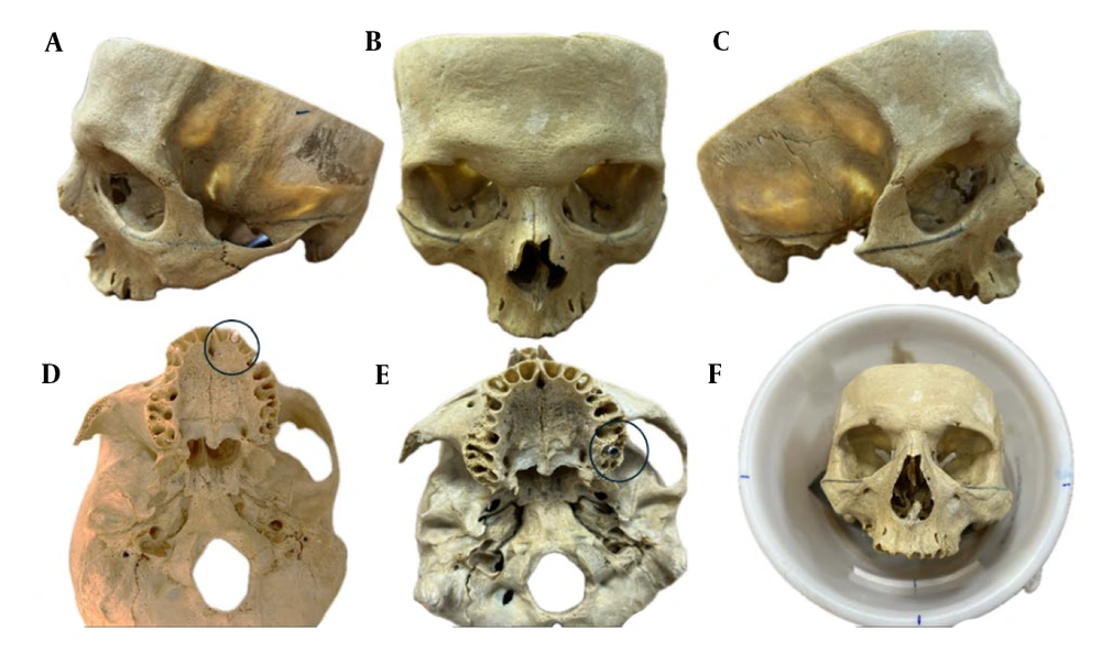 Lateral (A and C) and frontal (B) views of the dry human skull with the Frankfort plane marked; axial views showing the anterior (D) and posterior (E) implant placement sites marked with circles. The skull positioned within a water-filled cylinder ensuring the Frankfort plane is perpendicular to the horizontal (F). Lateral (A and C) and frontal (B) views of the dry human skull with the Frankfort plane marked; axial views showing the anterior (D) and posterior (E) implant placement sites marked with circles. The skull positioned within a water-filled cylinder ensuring the Frankfort plane is perpendicular to the horizontal (F).