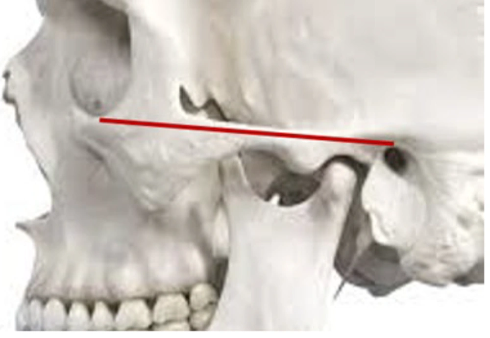 Schematic representation of the Frankfurt plane, defined as the horizontal plane passing through the lowest point on the inferior margin of the left orbit and the uppermost point on the external auditory meatus Schematic representation of the Frankfurt plane, defined as the horizontal plane passing through the lowest point on the inferior margin of the left orbit and the uppermost point on the external auditory meatus