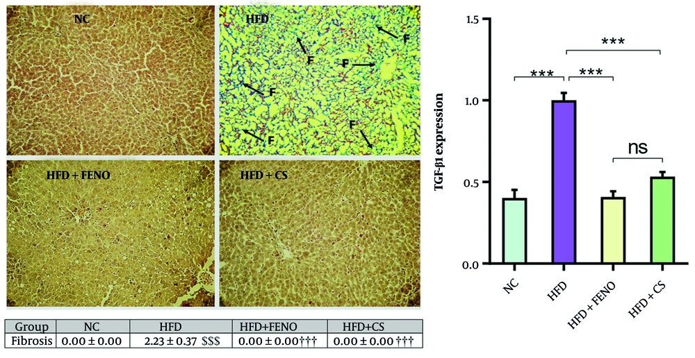 <i>Capparis spinosa</i> extract improves high-fat diet (HFD)-induced hepatic fibrosis in the non-alcoholic steatohepatitis (NASH) model. Upper panel: Representative images of Masson Trichrome stained liver tissue sections (magnification: 100X; abbreviation: F, fibrosis); middle panel: Quantitative histopathological assessment for fibrosis and collagen deposition; lower panel: Expression of hepatic transforming growth factor-beta (TGF-β) 1 mRNA in rats fed a HFD. Values are given as mean ± standard deviation (SD, CS: <i>Capparis spinosa</i>; Abbreviations: NC, normal control; FENO, fenofibrate; n = 7 - 8 rats; *** P < 0.001; $$$ P < 0.001 vs. NC; ††† P < 0.001 vs. HFD). <i>Capparis spinosa</i> extract improves high-fat diet (HFD)-induced hepatic fibrosis in the non-alcoholic steatohepatitis (NASH) model. Upper panel: Representative images of Masson Trichrome stained liver tissue sections (magnification: 100X; abbreviation: F, fibrosis); middle panel: Quantitative histopathological assessment for fibrosis and collagen deposition; lower panel: Expression of hepatic transforming growth factor-beta (TGF-β) 1 mRNA in rats fed a HFD. Values are given as mean ± standard deviation (SD, CS: <i>Capparis spinosa</i>; Abbreviations: NC, normal control; FENO, fenofibrate; n = 7 - 8 rats; *** P < 0.001; $$$ P < 0.001 vs. NC; ††† P < 0.001 vs. HFD).