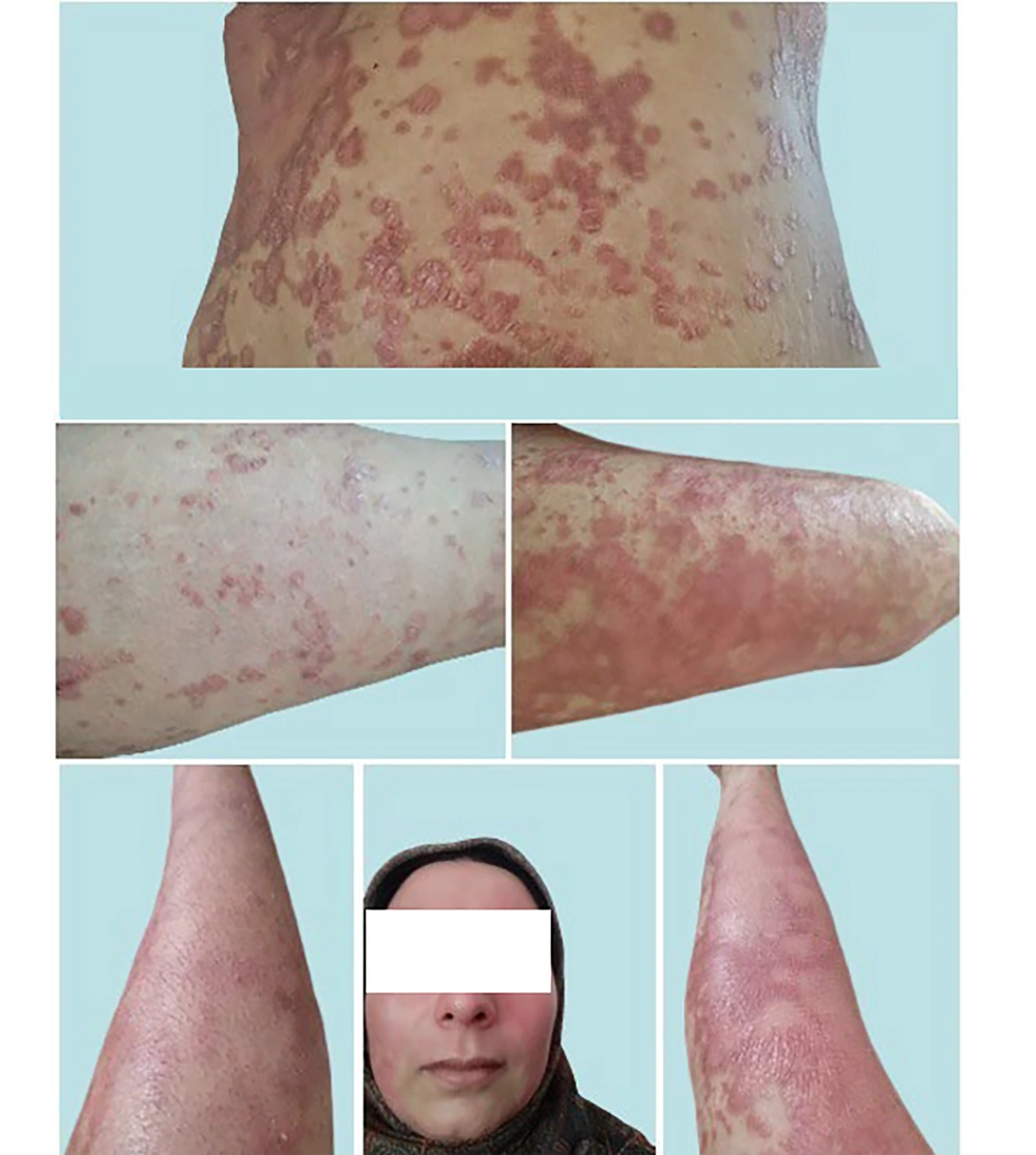 Post-treatment skin images of (top) abdominal skin erythrodermic psoriasis (EP) lesions (middle) EP lesions on the anterior lower extremities and (bottom) improved old lesions on the face and upper extremities (10 - 30 September, 2023). Post-treatment skin images of (top) abdominal skin erythrodermic psoriasis (EP) lesions (middle) EP lesions on the anterior lower extremities and (bottom) improved old lesions on the face and upper extremities (10 - 30 September, 2023).
