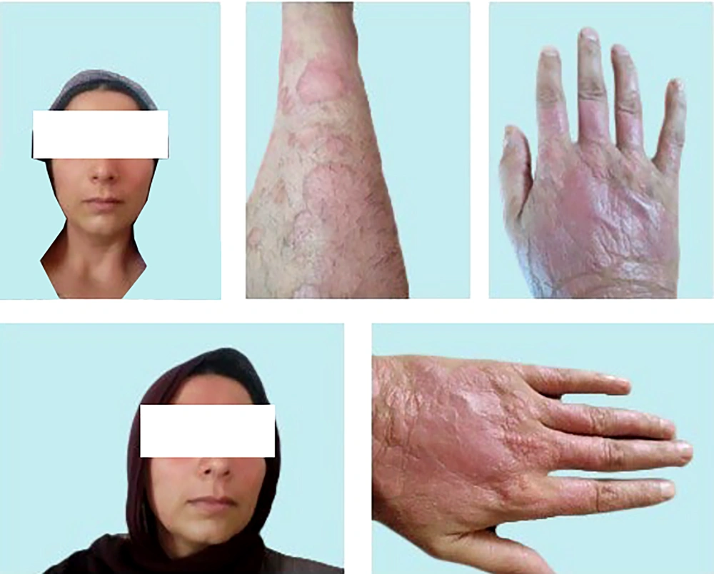 Post-treatment skin images of face lesions (top/bottom, left images), and lower/upper extremities (other images), about one month (late July, 2023) after the first intervention attempt using InflAQ (twice a day), along with Vaseline/Petroleum jelly (twice a day) as an emollient. Post-treatment skin images of face lesions (top/bottom, left images), and lower/upper extremities (other images), about one month (late July, 2023) after the first intervention attempt using InflAQ (twice a day), along with Vaseline/Petroleum jelly (twice a day) as an emollient.