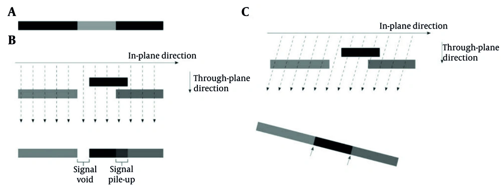 Schematic representation of the view angle tilting (VAT) technique: A, Homogeneous magnetic field; B, Distorted field without VAT correction; and C, Distorted field with VAT correction. In panel (B), field distortions result in signal voids and signal pile-up in the imaging slice, caused by magnetic field inhomogeneities. In panel (C), applying a readout-direction tilt (VAT) reduces these distortions; however, this comes at the cost of edge blurring and decreased boundary sharpness, indicated by the black arrows. Schematic representation of the view angle tilting (VAT) technique: A, Homogeneous magnetic field; B, Distorted field without VAT correction; and C, Distorted field with VAT correction. In panel (B), field distortions result in signal voids and signal pile-up in the imaging slice, caused by magnetic field inhomogeneities. In panel (C), applying a readout-direction tilt (VAT) reduces these distortions; however, this comes at the cost of edge blurring and decreased boundary sharpness, indicated by the black arrows.