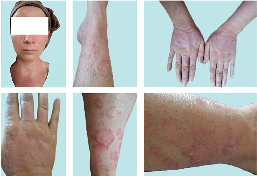 Pre-treatment skin images of face/neck lesions (top, left image), and lower/upper extremities (other images). In that time (early July, 2023) and long before the intervention with InflAQ, the patient was only using vaseline/petroleum jelly (twice a day) as an emollient and had absolutely preferred not to use any usual disease-modifying topical treatment. She accepted this type of intervention (InflAQ included in cream base, USP/BP), which is only based on the natural compound. Her daily living activities were severely affected (for several years) by the burden of widespread psoriatic skin lesions (only in face/neck/extremities, almost with no itching). Pre-treatment skin images of face/neck lesions (top, left image), and lower/upper extremities (other images). In that time (early July, 2023) and long before the intervention with InflAQ, the patient was only using vaseline/petroleum jelly (twice a day) as an emollient and had absolutely preferred not to use any usual disease-modifying topical treatment. She accepted this type of intervention (InflAQ included in cream base, USP/BP), which is only based on the natural compound. Her daily living activities were severely affected (for several years) by the burden of widespread psoriatic skin lesions (only in face/neck/extremities, almost with no itching).