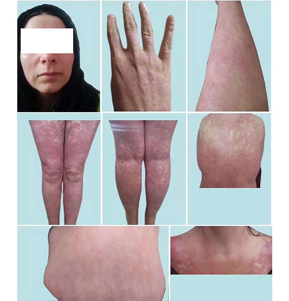 Post-treatment skin images of (top) improved face/extremities lesions (middle) posterior skin lesions, anterior lower extremities, posterior lower extremities (bottom) improved abdominal/chest EP lesions (20 October, 2023). Post-treatment skin images of (top) improved face/extremities lesions (middle) posterior skin lesions, anterior lower extremities, posterior lower extremities (bottom) improved abdominal/chest EP lesions (20 October, 2023).