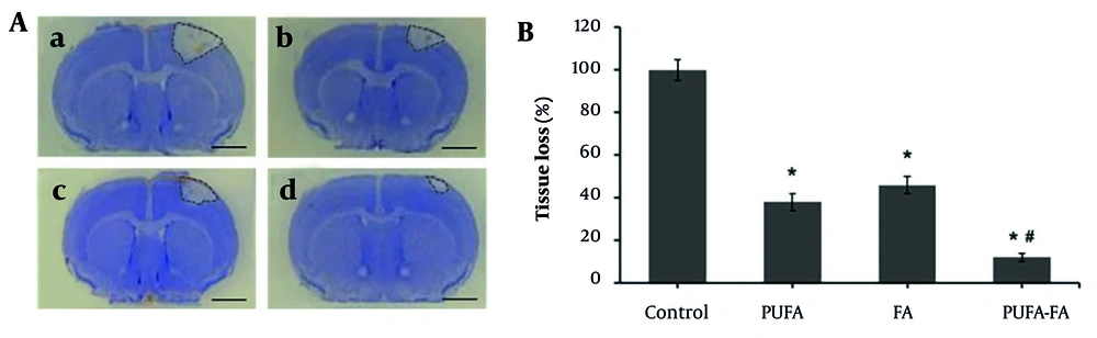 Effect of polyunsaturated fatty acid (PUFA) and folic acid (FA) on long-term neuroprotection against neonatal hypoxic ischemia (HI) brain injury. A, representative photographs of cresyl violet-stained brain coronal sections (n = 3): a, HI control group; b, PUFA-treated group; c, FA-treated group; d, PUFA-FA-treated group. B, quantification of tissue loss and representation of data as a percentage of HI control (100%; * P < 0.05 vs. control; # P < 0.05 vs. PUFA or FA groups; injury areas are marked with lines across them; scale bar 1 mm). Effect of polyunsaturated fatty acid (PUFA) and folic acid (FA) on long-term neuroprotection against neonatal hypoxic ischemia (HI) brain injury. A, representative photographs of cresyl violet-stained brain coronal sections (n = 3): a, HI control group; b, PUFA-treated group; c, FA-treated group; d, PUFA-FA-treated group. B, quantification of tissue loss and representation of data as a percentage of HI control (100%; * P < 0.05 vs. control; # P < 0.05 vs. PUFA or FA groups; injury areas are marked with lines across them; scale bar 1 mm).