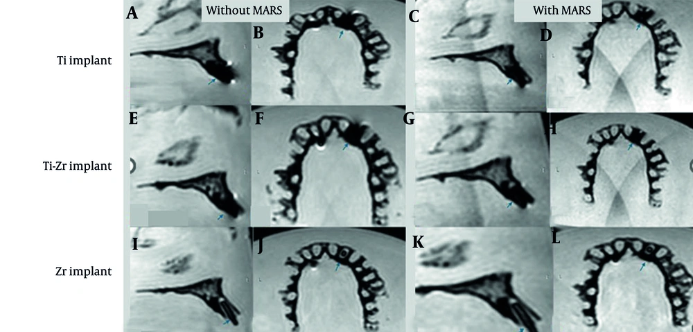 T2-weighted (T2W) magnetic resonance imaging (MRI) images for titanium (Ti), titanium-zirconium (Ti-Zr), and zirconia (Zr) implants in the anterior maxillary region, without (A, B, E, F, I, and J) and with (C, D, G, H, K, and L) metal artifact reduction sequences (MARS) technique (Blue arrows denote to implant site). T2-weighted (T2W) magnetic resonance imaging (MRI) images for titanium (Ti), titanium-zirconium (Ti-Zr), and zirconia (Zr) implants in the anterior maxillary region, without (A, B, E, F, I, and J) and with (C, D, G, H, K, and L) metal artifact reduction sequences (MARS) technique (Blue arrows denote to implant site).