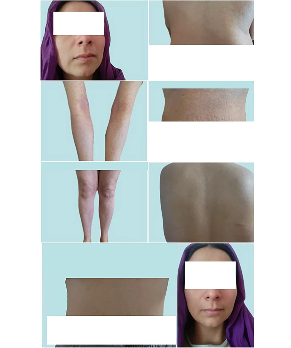 Post-treatment skin images of (top, November 2023) face/posterior skin, (middle, December 2023) hand/abdominal skin, (middle, April, 2024) anterior lower extremities and posterior skin, (bottom, April 2024) face/abdominal skin. Post-treatment skin images of (top, November 2023) face/posterior skin, (middle, December 2023) hand/abdominal skin, (middle, April, 2024) anterior lower extremities and posterior skin, (bottom, April 2024) face/abdominal skin.