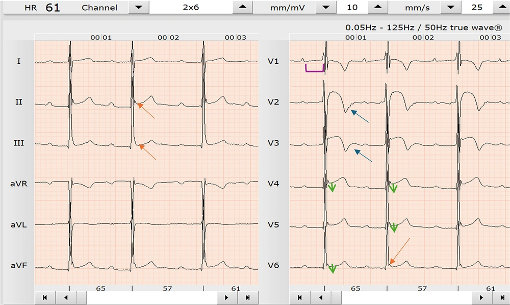Note the J-point elevation, ST-segment elevation II, III aVF, V3, V4, V5, and T-wave inversions confined to V2-V3 and atrioventricular (AV)-block 1st degree of 23-year-old male Note the J-point elevation, ST-segment elevation II, III aVF, V3, V4, V5, and T-wave inversions confined to V2-V3 and atrioventricular (AV)-block 1st degree of 23-year-old male